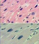 What has happened to these cardiac myocytes from the top slide to the bottom slide and why