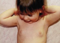 Isolated early breast development in females.
The usual age of onset for this is 12-24 months.It occurs due to small transient bursts of estrogen from the prepubertal ovary of from increased sensitivity to low levels of estrogen in the prepubertal...