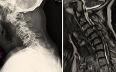 neutral lateral cervial radiographs and corresponding T2-weighted MRI of  pts w/ sx & PE w/ cervical myelopathy. In which of these patients would a cervical laminoplasty alone be contraindicated as surgical treatment?