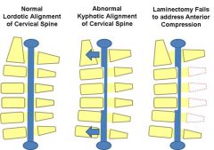 Laminoplasty alone as surgical tx is contradindicated in pts w/ rigid cervical kyphosis of > 13 degrees, obtaining flex/ext films, one can determine if the kyphotic deformity is rigid or not.
