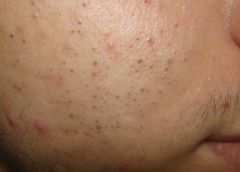 A comedo is a clogged hair follicle (pore) in the skin. Keratin (skin debris) combines with oil to block the follicle. A comedo can be open (blackhead) or closed by skin (whitehead), and occur with or without acne. The word comedo comes from Latin...