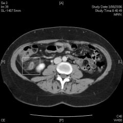 ** Acute appendicitis is a clinical diagnosis. Laboratory findings (mild leukocytosis) are only supportive. Radiographs or other imaging studies re unnecessary unless the diagnosis is uncertain or the presentation is atypical
- CT scan (sensitivi...