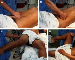 1. tenderness in RLQ (maximal tenderness at McBurney's point- 2/3 of the distance from the umbilicus to the right anterior superior iliac spine)
2. rebound tenderness, guarding, diminished bowel sounds
3. low grade fever (may spike if perforatio...
