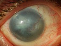 Ocular Conditions associated with Aniridia 
1-5.