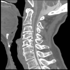 myelopathy and neurogenic claudication in a pt w\ lum degen spondylolithesis. CT myelo C spine is next step in management, sx tandem stenosis can present w/ a confusing scenario of both neurogenic claudication and myelopathy. The prevalence has be...