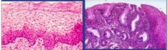 What adaptive cellular response has occurred from the esophageal epithelium on the left to that on the right