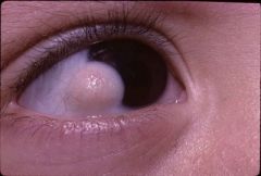 1. Cartilage
2. Adipose
3. Lacrimal Gland
Limbal Dermoid w/Goldenhar Syndrome: Oculoauriculvertebral syndrome 
1. Hemifacial microsomia, ear deformities, upper eyelid colobomas, and vertebral anomalies
