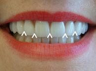 A triangular space in the gingival direction between the proximal surfaces of two teeth in contact.