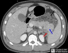 1. Abdominal xray- limited role in the diagnosis of acute pancreatitis 
 - more helpful in ruling out other diagnosis- such as intestinal perforation (free air). The presence of calcifications can suggest chronic pancreatitis.
- In some cases, o...