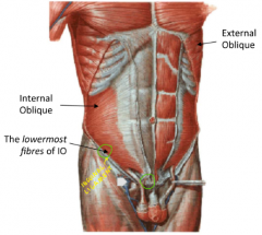 1. Superomedial fibre arrangement (perpendicular to EO)



2. Topmost fibres arise from post. ab wall fascia

 Lowermost fibres arise from lateral 2/3 of inguinal ligament and arch up


3. Topmost fibres insert on to costal margin  
Lowermost fibr...
