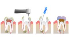 "Root canal treatment"


 


Involves removing the entire pulp from a tooth.


Treatment with zinc oxide-eugenol and a permanent restoration.