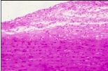 What has occurred here to the macrophages in smooth muscle in someone with atherosclerosis