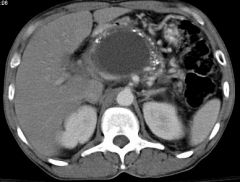 1. pancreatic pseudocyst- encapsulated fluid collection that appears 2 to 3 weeks after an acute attack-- unlike a true cyst, it lacks an epithelial lining
2. complications of untreated pseudocysts include rupture, infection, gastric outlet obstr...