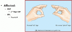 anterterior interosseus syndrome (left)
