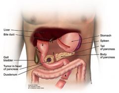 1. Surgical resection (whipple's procedure - pancreaticoduodectomy) is the only hope of cure-- however, only a minority of tumors are resectable (roughly 10%). The prognosis is grim even after resection, with a 5-year survival of 10%
2. If the tu...