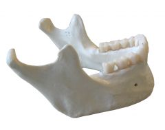 Deep pit or socket in maxillae or mandible