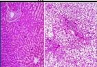 What has caused to the normal liver cells on the left to change them to those on the right in someone with chronic alcoholism/alcohol poisoning