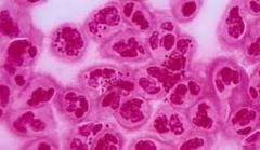 Caused by Neisseria gonorrhea. also known as gonococci (plural), or gonococcus (singular), is a species of Gram-negative coffee bean-shaped diplococci bacteri.  Spread through sexual contact.  