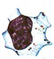reactive lymphocyte

features: wandering or ballerina skirt cytoplasm, bluer periphery, coarse nuclear cytoplasm or smudged. 