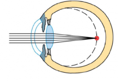 Near-sightedness

Focal point falls in front of the retina

Eyeball is elongated

Fixed with a concave lens