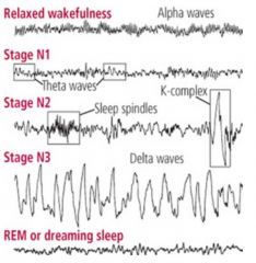 4 stages 
1. low voltage, mixed frequency pattern on EEG
2. Appearance of sleep spindles + K complexes
3. High amplitude delta rhythm 
4. Slow wave sleep, synchronisation 

may be MSK movement but no eye movement 