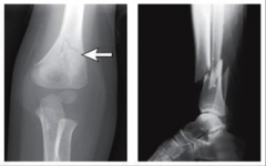 What
are these fractures called and what is the major difference between them?
 