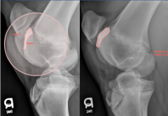 CdL-CrMO

lateral trochlear ridge of femur

-soft tissue opacity, reduced visibility of patellar lig
defect on lateral trochlear ridge, heterogenity 
reduced bone opacity, sclerosis