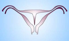 septate uterus due to malfusion of the paramesonephric ducts. 
Uterine septae are nads of collagen fiber positioned vertically within the uterus. Because these fibers do not have good blood supply they cannot support placental implantation and 2...