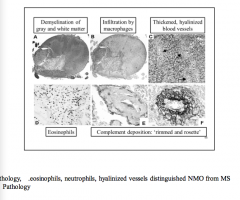 Eosinophils, neutrophils, hyalinized vessels