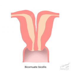 uterine anomaly involving a "heart-shaped" uterus with two horns. Pregnancy/implantation can occur in either horn. If IUDs are used for contraception that an IUD is needed in both horns.
There is increased risk for second trimester pregnancy loss...
