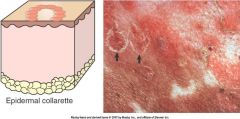 a secondary skin legion. 
a circular rim of loose scale ( keratin ) that began life as a pustule/vesicle/bulla
