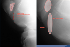 changes to articular margin or patella and lateral femoral trochlea

irregular margin defect to subchondral bone - lucency in bone