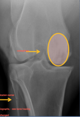 osseous cyst-like lesion

secondary degenerative joint disease

progressive extensive bone sclerosis
heterogenous radiolucency into femoral condyle

osteophyte on condyle, epicondyle, medial condyle, intercondylar eminence

sclerotic chan...