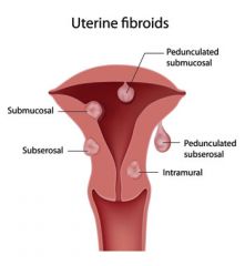 Uterine fibroids are classified by their location within the uterus. This includes:
1. submucosal (beneath the endometrium)
2. intramurual (in the muscular wall of the uterus)- most common type
3. subserousal (beneath the uterine serosa)
4. pedun...