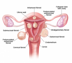intramural (in the muscular wall of the uterus)