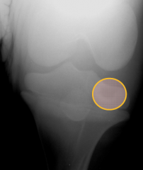 osseous cyst like lesion

proximal tibia

uniform bone opacity - radiolucency to articular margin