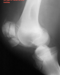 fractured patella
comminuted fracture
damage to medial femoral trochlea

skyline view