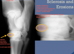 DJD
Sclerosis and Erosions

DLPMO view

sclerosis and erosion, distal central, proximal 3rd tarsal

no joint space definition
variable in appearance, focally surrounding DJD or entire central and 3rd tarsal bone
lose cortex/medullary dist...