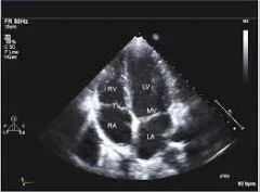 A picture of an echo 4 chambers view:
A Anterior mitral valve leaflet 
B Posterior mitral valve leaflet 
C ? Aortic non-coronary 
D ? Tricuspid 
E