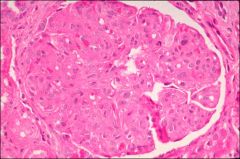What pathologic features are seen in this image?


 


What syndrome and disease might this be associated with?