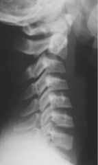 Cervical spine injuries should be immobilized in a postion of relative extension in both children and adults. Applying cervical traction with the external auditory meatus in-line with the shoulders can serve as a guideline.

Herzenberg et al. fo...