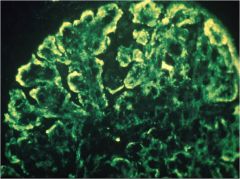 What pattern is seen in this immunofluorescent image?


 


What syndrome(s) and disease(s) is it associated with?