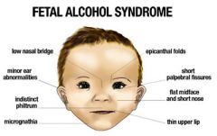 U9 Dev Psych     



Physical and cognitive abnormalities in children caused by a pregnant woman's heavy drinking. In severe cases, symptoms include noticeable facial proportions.
