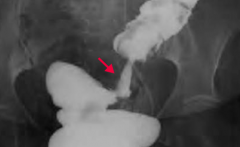 Your patient gets a barium enema x-ray, and this is the finding in the sigmoid colon, what do you think of?