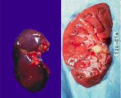 What has occurred to this kidney