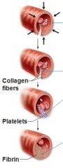 1.The Vascular Phase: Local contraction of injured vessel

2. The Platelet Phase: Platelets stick to damaged vessel wall

3. The Coagulation Phase: Clotting factors in plasma form blood clot      