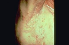 What type of lesion is this? Primary or Secondary?