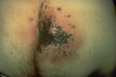 What type of lesion is this? Primary or Secondary?