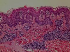 What are some histologic features of Exanthematous drug eruption?