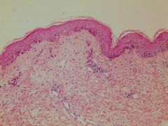 1. Perivascular lymphocytic infiltrate (some eosinophils)
2. Few necrotic keratinocytes
3. Mild peripheral eosinophilia (20-40% of pts) 

*also note spongiosus (fluid in skin).